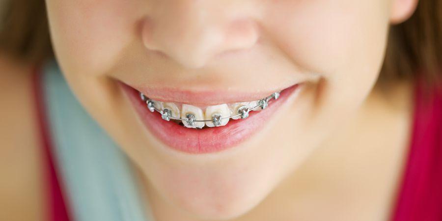 Kieferorthopädischer Befund bei Kindern? Entweder schief oder teuer!